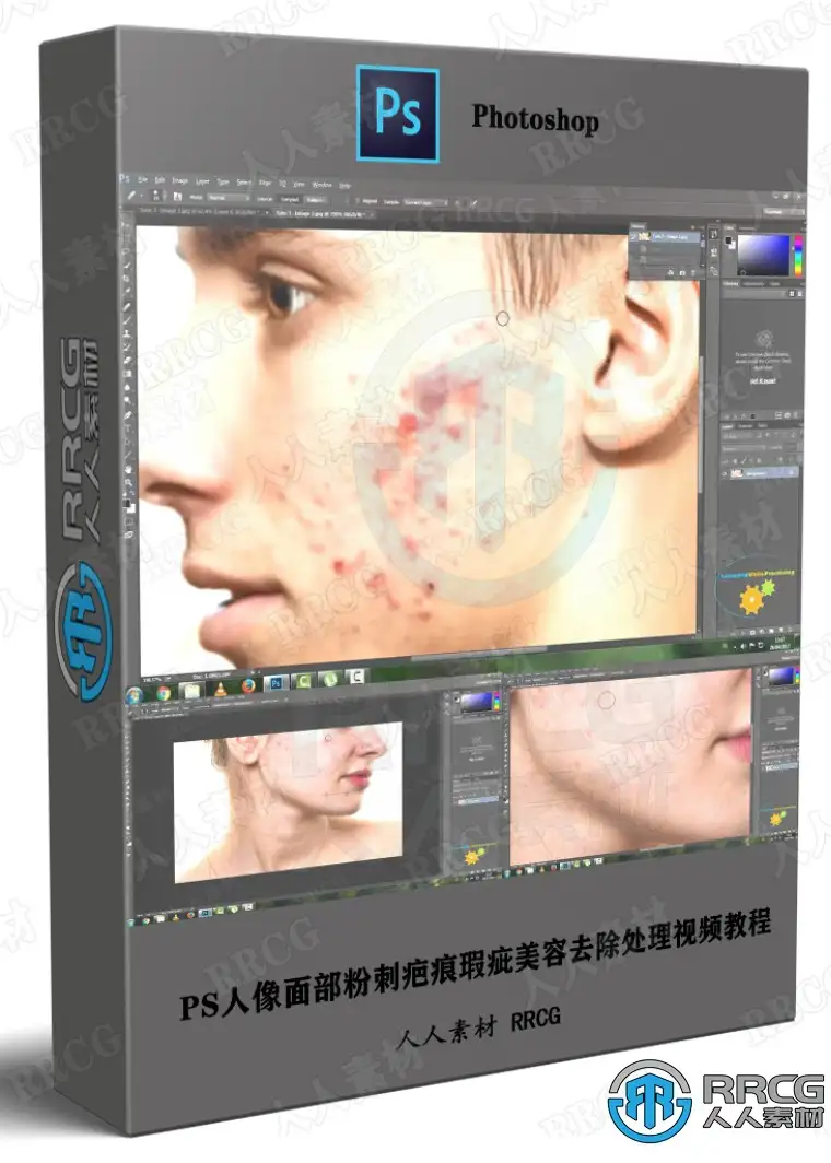 PS人像面部粉刺疤痕瑕疵美容去除处理视频教程